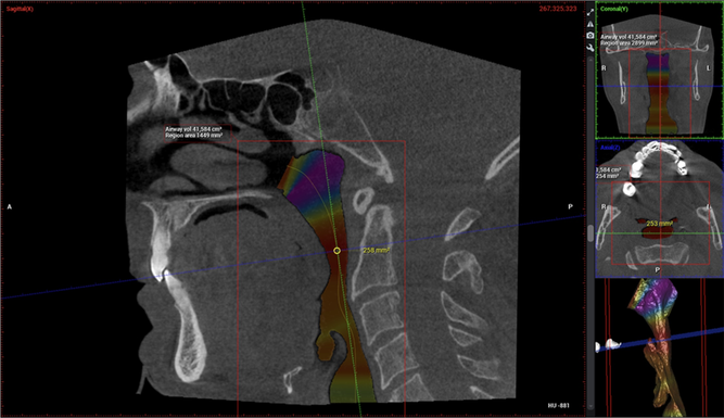 Example of CBCT image showing the volume of the airway